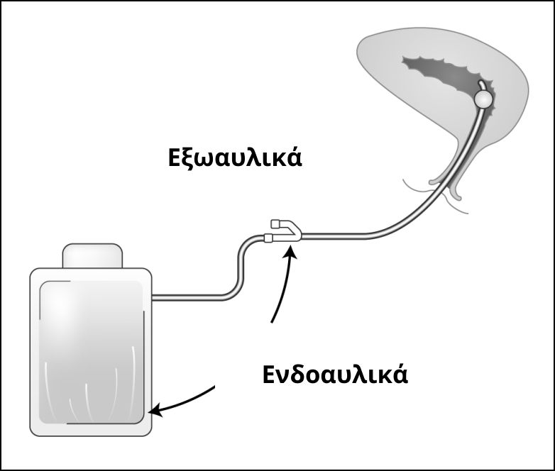 Ενδοαυλικές και εξωαυλικές ουρολοιμόξεις και που εντοπίζονται στο σύστημα καθετήρα - σωλήνα παροχέτευσης και ουροσυλλέκτη