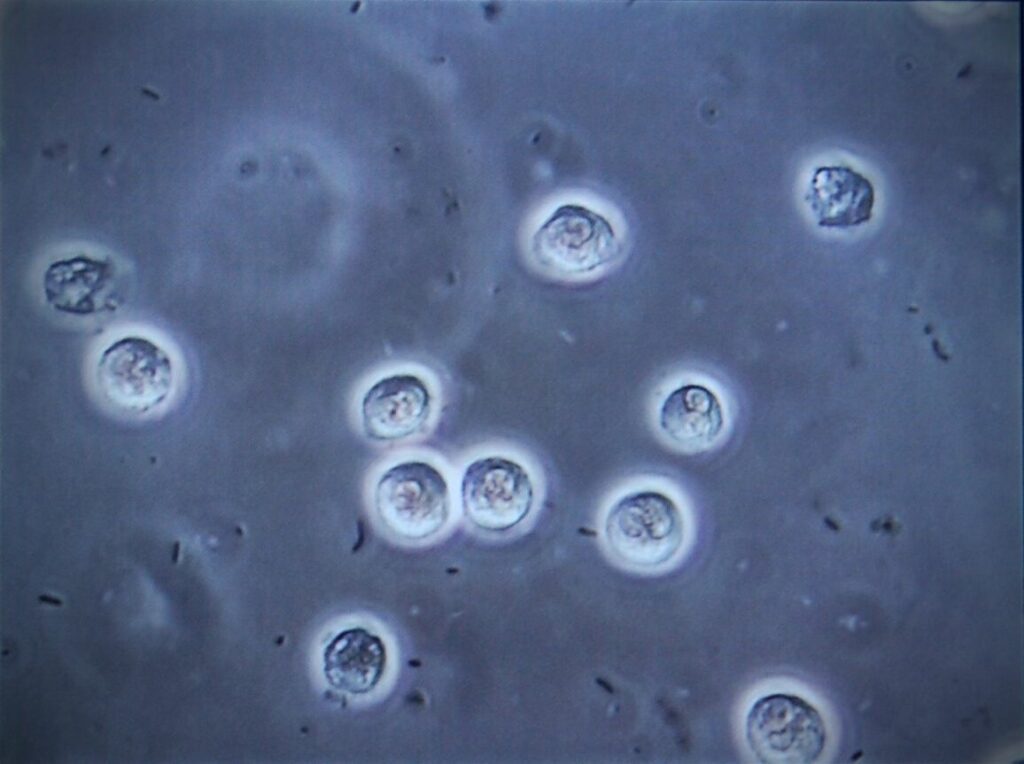 Πως φαίνεται η βακτηριουρία στο μικροσκόπιο