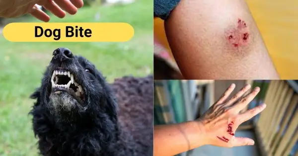 Dog Bite: How to Treat It and How to Enhance Wound Healing?